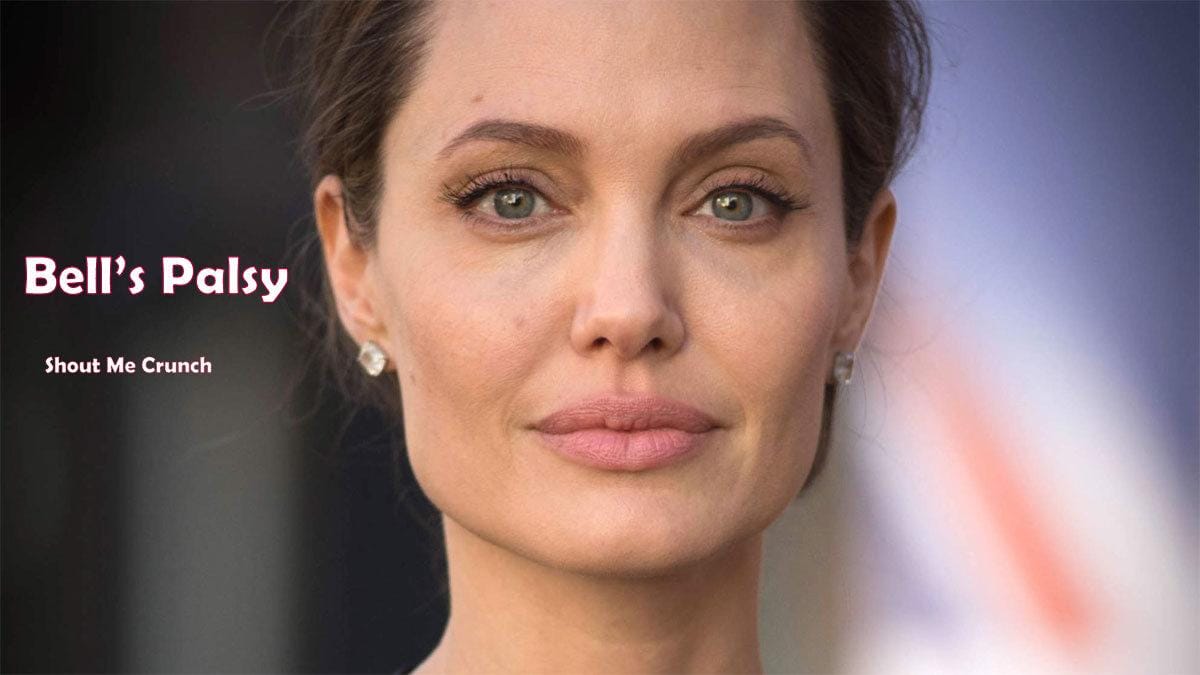 Bell’s Palsy Bell’s Palsy