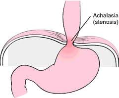 achalasia cardia