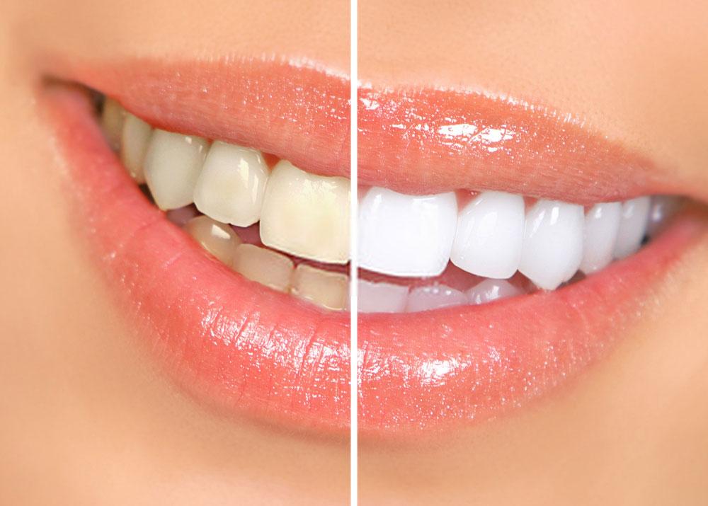 teeth-whitening teeth-whitening