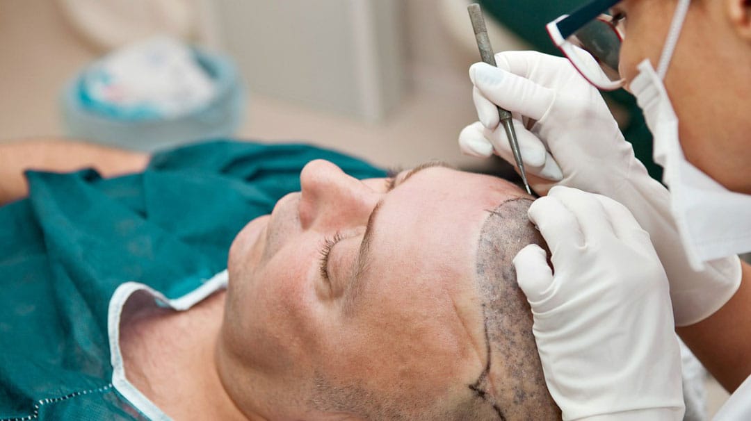 Hair Transplant Permanent