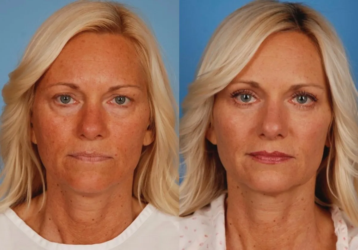 Eyelid Surgery